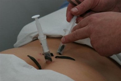 Пиявки и целлюлит