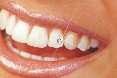 Бриллианты в зубах