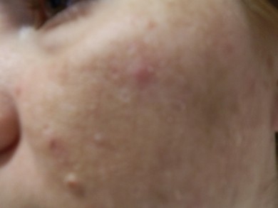 Пигментные пятна на лице