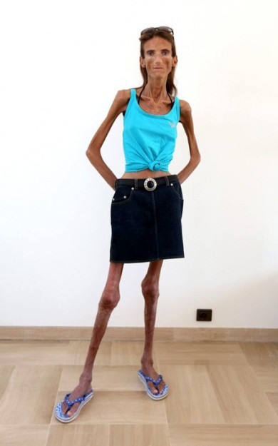 Самая худая женщина мира весит.... 25 кг