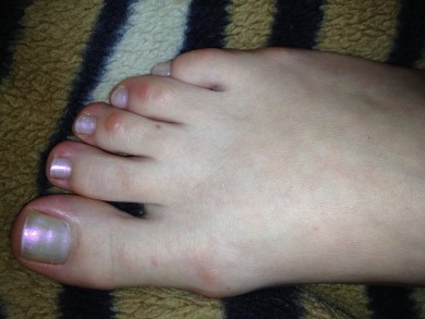 Как избавиться к лету от мозоли ?