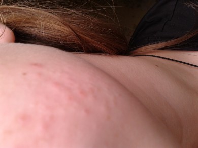 Проблема с лицом уже 2-ой месяц