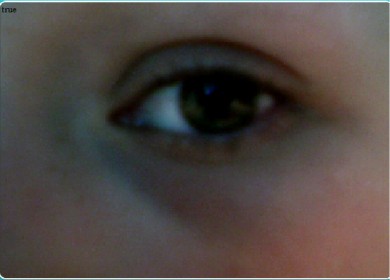 Синяки подглазами мешают жить! Помогите!