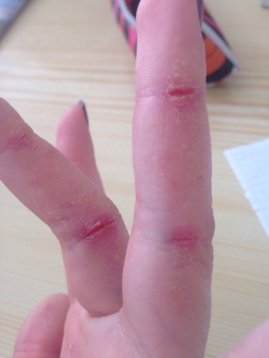 обострение хронической экземы