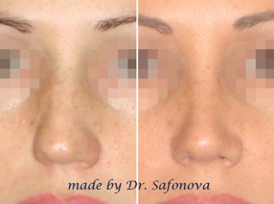 Ринопластика, операция на носу